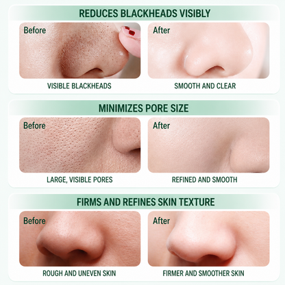 SHUSHUO Pore Cleansing Bubble Nose Mask